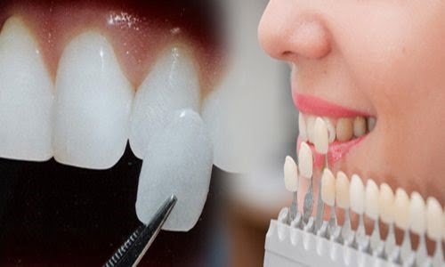 1 hàm răng sứ bao nhiêu tiền là duy trì kết quả lâu nhất? 1