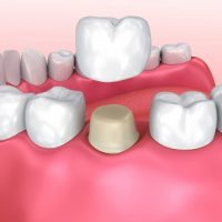 Răng đã lấy tủy có nên bọc sứ không?