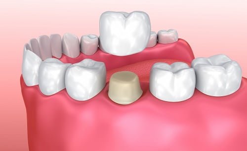 Răng đã lấy tủy có nên bọc sứ không?