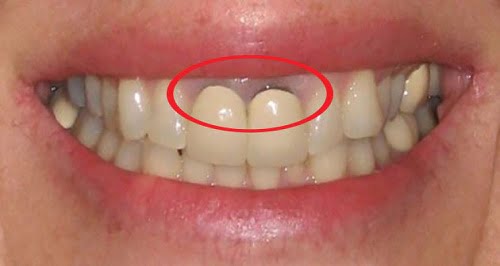 Răng sứ bị đen viền nướu do đâu? Cách khắc phục là gì?