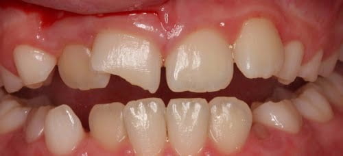 Răng sứ bị mòn - Nhận định từ chuyên gia nha khoa 2