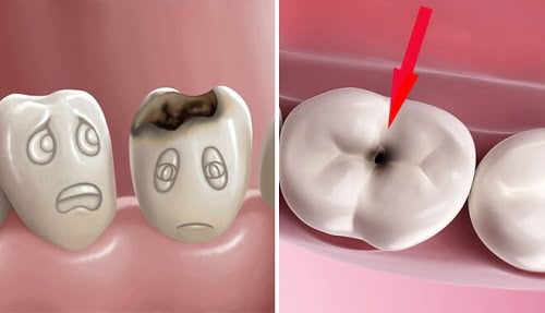 Răng sứ bị sâu khi nào? Có nên tháo răng sứ khi bị sâu răng? 1