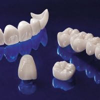 Răng sứ có bị sâu không? Làm gì để bảo vệ răng sứ?
