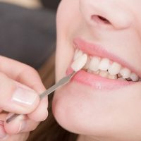 Răng sứ có mài được không khi bị dài hơn răng thật?
