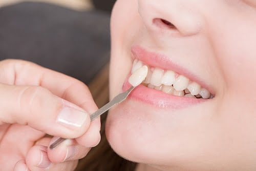 Răng sứ có mài được không khi bị dài hơn răng thật?