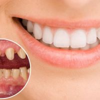 Răng sứ gây hôi miệng - Cách khắc phục hiệu quả cho bạn