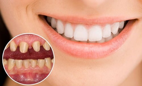 Răng sứ gây hôi miệng - Cách khắc phục hiệu quả cho bạn