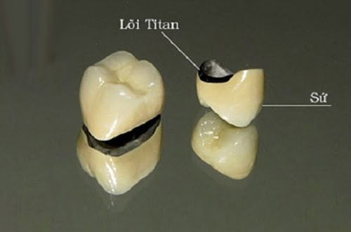 Răng sứ titan có bị đen không?