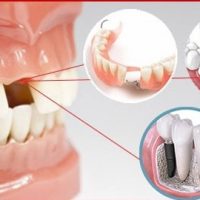 Kỹ thuật trồng răng implant chuẩn quốc tế tại nha khoa
