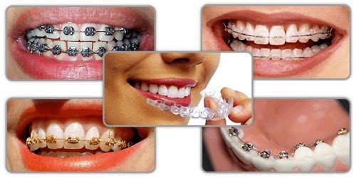 Niềng răng giai đoạn nào đau nhất? Cần lưu ý những gì?