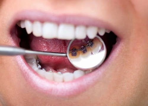 Niềng răng mặt trong mất bao lâu là răng đẹp hoàn thiện? 1