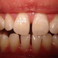 Răng cửa thưa có niềng được không để có hàm răng đẹp?