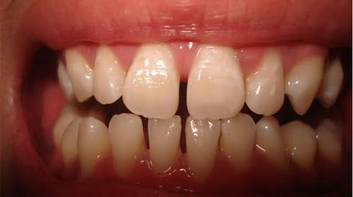 Răng cửa thưa có niềng được không để có hàm răng đẹp?