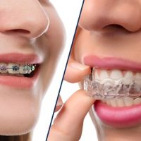 Niềng răng bị hỏng bạn cần phải làm gì để khắc phục?