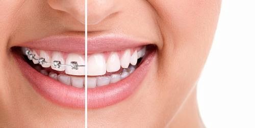 Niềng răng bị lòi chân răng nguyên nhân do đâu? 3