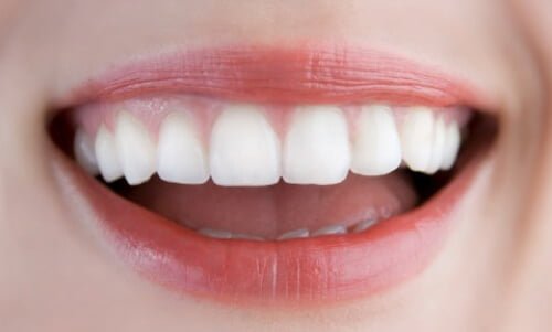 Bọc sứ răng thưa bao nhiêu tiền? Chăm sóc răng sứ thế nào? 1