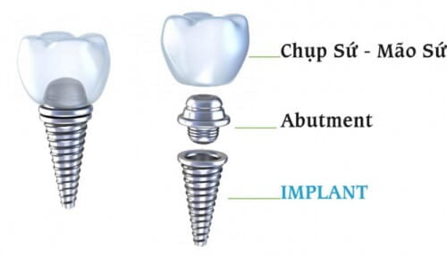 Giá răng sứ implant cho răng hàm như thế nào? 1