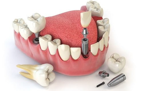 Giá răng sứ implant cho răng hàm như thế nào? 3