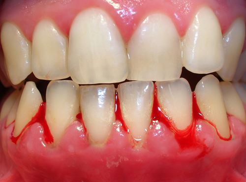 Lấy cao răng có đau hay không? Tìm hiểu cách thực hiện 2