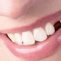 Trồng răng giả có đau không? Có gây biến chứng gì không?