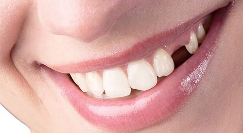 Trồng răng giả có đau không? Có gây biến chứng gì không?