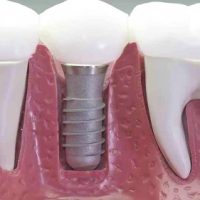 Cấy ghép răng implant có tốt không? Thông tin cần tìm hiểu