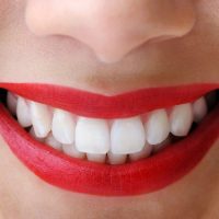 Có nên tẩy trắng răng nhiều lần? Nha khoa khuyến cáo