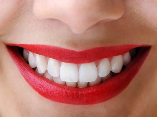 Có nên tẩy trắng răng nhiều lần? Nha khoa khuyến cáo