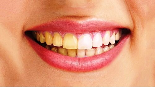 Có nên tẩy trắng răng nhiều lần? Nha khoa khuyến cáo 2