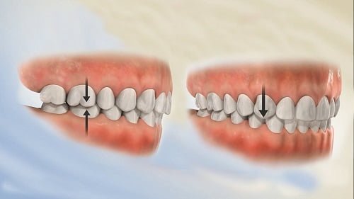 Niềng răng chỉnh hàm lệch có hiệu quả không? 2