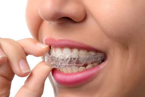 Niềng răng invisalign có nhổ răng không? Bác sĩ giải đáp