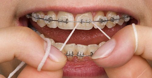 Niềng răng bị viêm lợi - Cách xử lý dứt điểm 1
