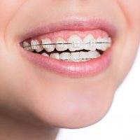Niềng răng có nên dùng bàn chải điện? Giải đáp từ nha khoa