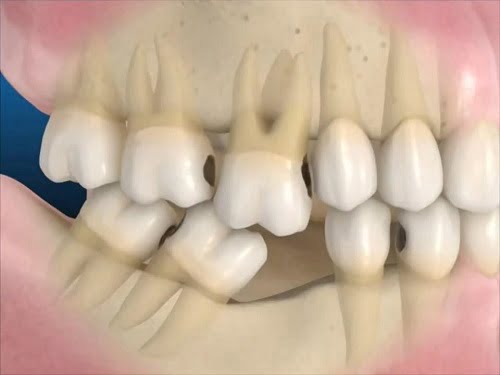 Trồng răng giả mất bao lâu với từng phương pháp? 1