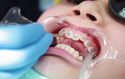 Niềng răng lúc nào đau nhất? Tìm hiểu quy trình 2