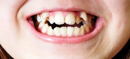 Niềng răng lộn xộn - Giải pháp thẩm mỹ cho khuôn hàm 1