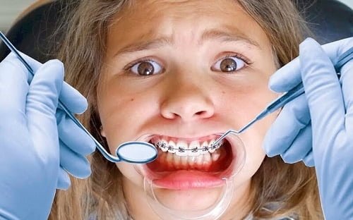 Niềng răng xong bị móm - Nguyên nhân chính 2