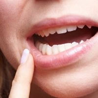 Nhổ 2 răng khôn hàm trên một lần có nên hay không?