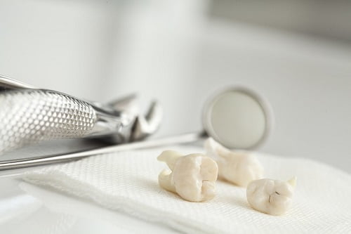 Nhổ răng khôn an toàn với công nghệ nhổ răng không đau*