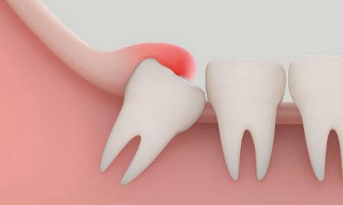 Sưng lợi ở răng khôn - Cách điều trị hiệu quả 1
