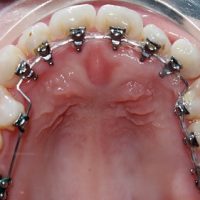 Niềng răng phải nhổ răng nào là hợp lý nhất? Tìm hiểu