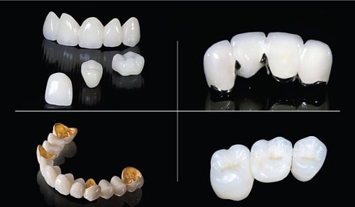 Trồng răng bằng cầu răng - Giải pháp cho bạn 3