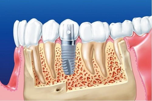 Trồng răng implant có đau không? Tìm hiểu cách thực hiện 1