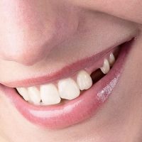 Mất răng lâu năm có trồng được không?