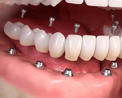 Kinh nghiệm làm răng implant hữu ích cho bạn