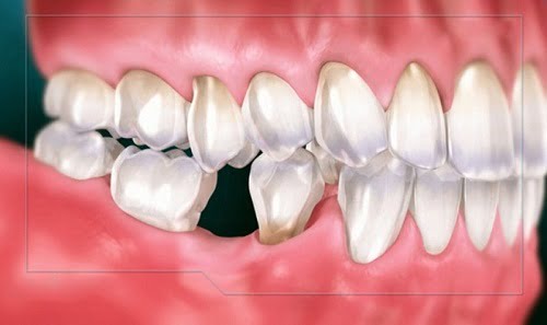 Trồng răng sứ bị đen chân răng - Cách xử lý hiệu quả 1