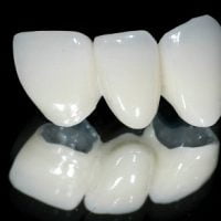 Có nên trồng răng sứ kim loại không? Giải đáp nha khoa