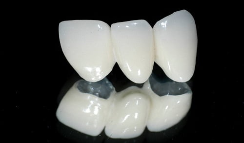 Có nên trồng răng sứ titan để phục hình không? 1